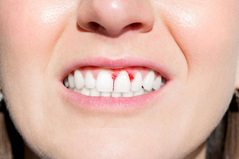女人口出血牙龈牙周疾病
