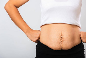 女人显示拉伸马克宽松的较低的腹部皮肤脂肪怀孕婴儿出生