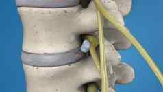 插图脊髓绳蓝色的背景内窥镜腰椎椎间盘摘除