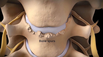 脊髓阀瓣椎间盘突出受伤缓冲连接<strong>组织</strong>椎骨