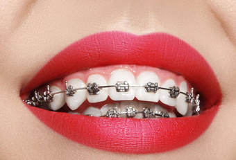 美丽的宏拍摄白色牙齿牙套牙科护理<strong>照片</strong>美女人<strong>微笑</strong>牙医配件
