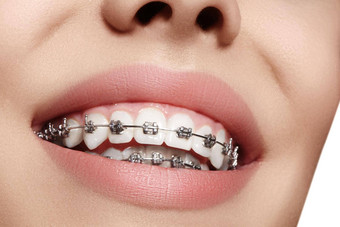美丽的白色牙齿牙套牙科护理<strong>照片</strong>女人<strong>微笑</strong>牙医配件口腔正畸学治疗