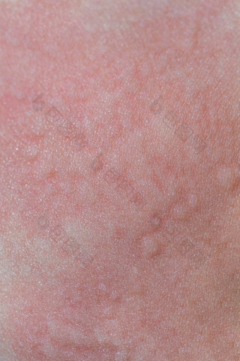 荨麻疹皮肤红色的点过敏反应皮肤孩子荨麻疹症状关闭