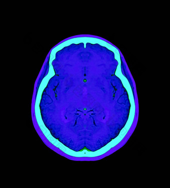 色彩斑斓的血管造影术大脑进行合作。大脑轴向冠状矢状面视图剪裁路径