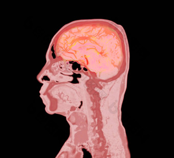 色彩斑斓<strong>的</strong>血管造影术大脑进行合作。大脑矢状面视图剪裁路径