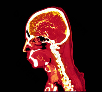 色彩斑斓的血管造影术大脑进行合作。大脑矢状面视图剪裁路径