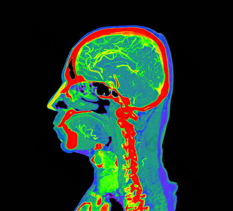 色彩斑斓<strong>的</strong>血管造影术大脑进行合作。大脑矢状面视图剪裁路径