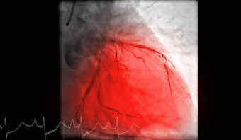 心脏导管插入术测试找到心脏逮捕
