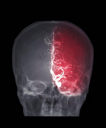 脑血管造影术视图图像透视干预放射学