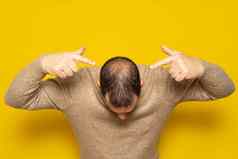 人类脱发头发损失中年拉丁美洲人男人。指出头高亮显示初期的脱发