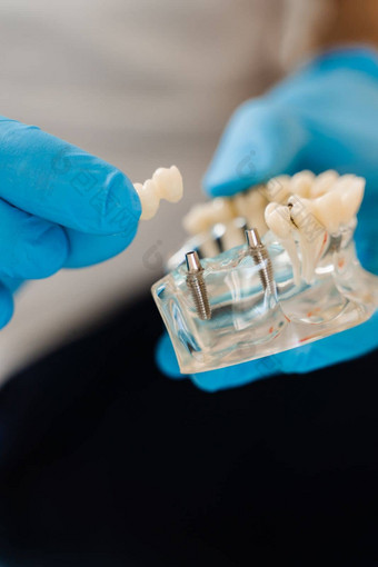 人工塑料<strong>下巴</strong>牙科植入物特写镜头牙科假肢植入物牙科假肢咨询牙医病人女人牙科
