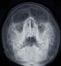 x射线图像鼻侧的鼻窦诊断鼻窦炎