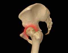 扫描骨盆骨臀部联合呈现诊断骨折骨盆骨臀部联合孤立的黑色的背景