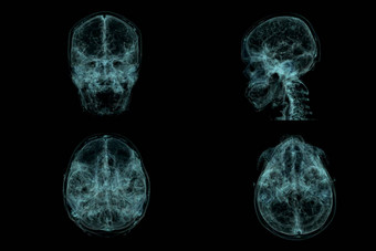 人类头骨大脑扫描x射线可视化内部头骨插图渲染