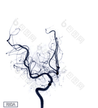 脑血管造影术图像黎加透视干预放射学显示脑动脉