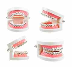 集牙齿模型金属线牙科牙套牙科仪器孤立的白色背景保存剪裁路径