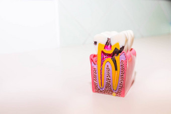 牙模型龋齿牙衰变牙医的办公室健康的牙齿概念大牙模型细节神经牙质搪瓷蛀牙脓肿牙科疾病复制空间