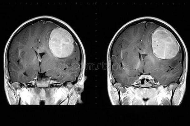 脑部核磁共振显示肿瘤