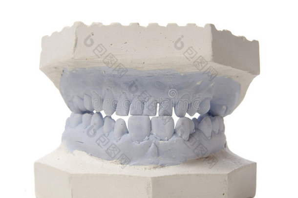 石膏牙模型