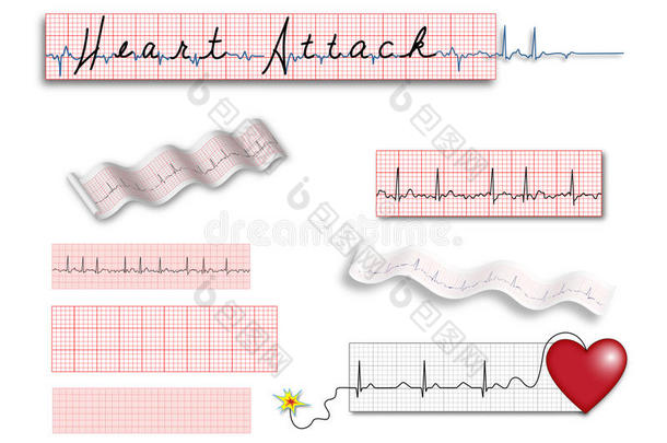 整版心电图带心脏病发作标题