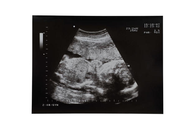 妊娠超声<strong>扫描</strong>图像