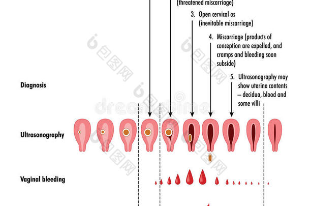 流产的<strong>分期</strong>和检测