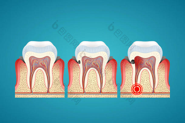 人类牙齿和牙龈<strong>龋齿</strong>的分期进展