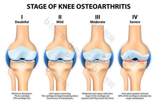 膝骨关节炎（oa）的<strong>分期</strong>。