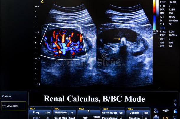 彩色<strong>超声</strong>监测图像。 肾结石