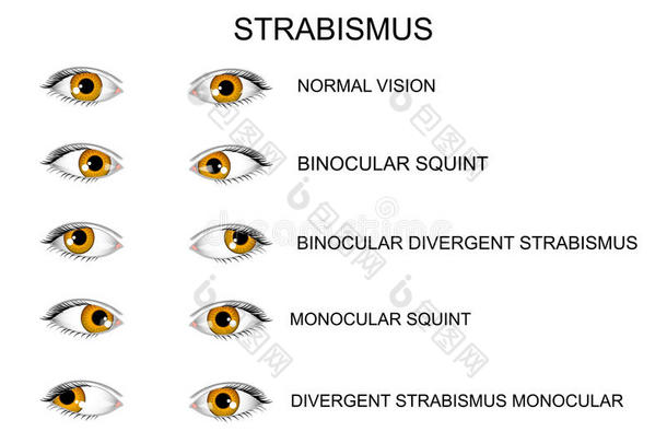 眼睛。 斜视的类型