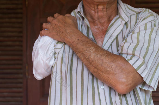 亚洲老人，一只手臂和手臂假肢