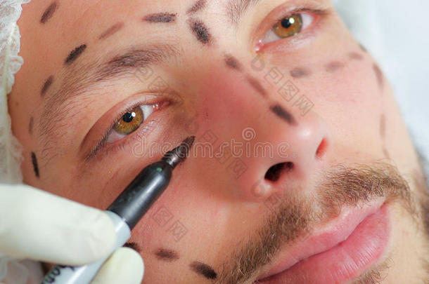 特写年轻人的脸准备整容手术，得到线在皮肤上用黑色标记，从看到