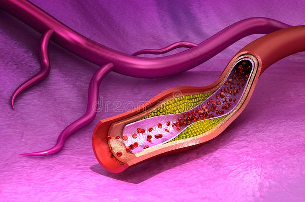 血管中胆固醇斑块，医学上准确的说明