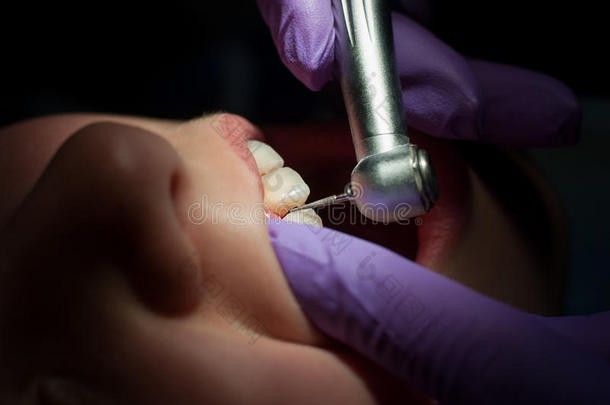 美牙和张口的牙科钻孔程序