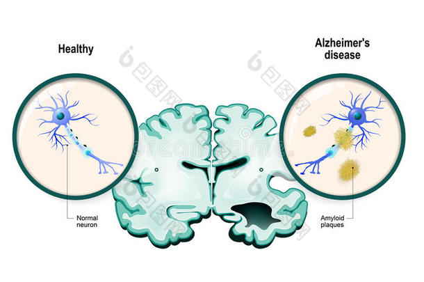 老年痴呆症。神经元和大脑