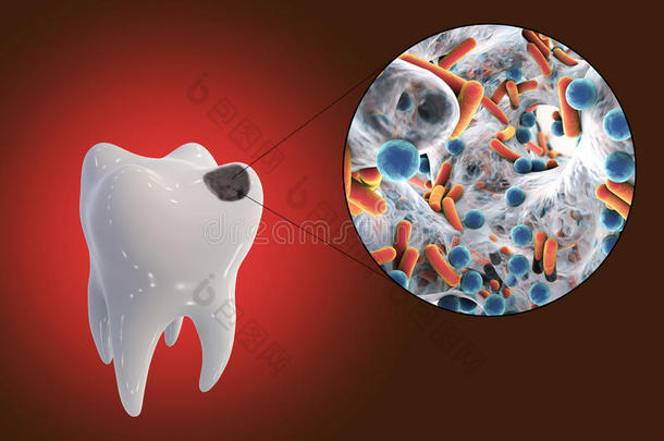 龋齿和导致龋齿的微生物的近距离观察