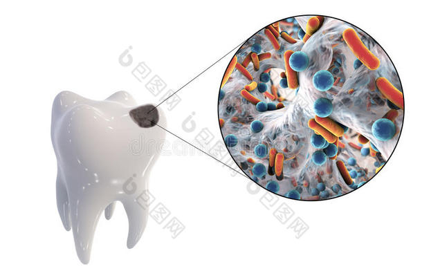 <strong>龋齿</strong>和导致<strong>龋齿</strong>的微生物的近距离观察