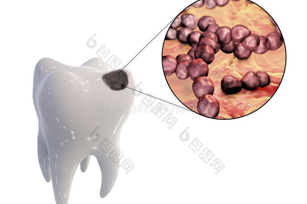 龋齿和导致龋齿的微生物的近距离观察