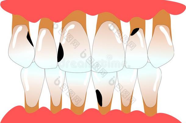 人位于前部的牙和牙周炎和龋齿