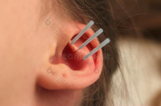 针灸关于指已提到的人耳朵和num.三针,耳朵和洞