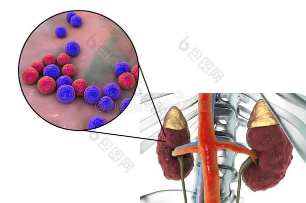 肾盂肾炎人为的在旁边细菌肠球菌