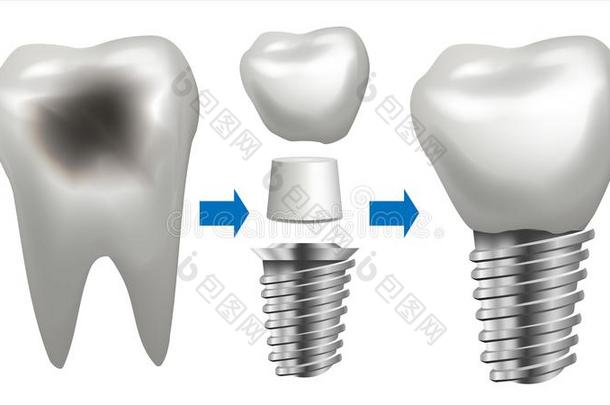 牙齿的移植物矢量.牙和龋齿.健康状况牙移植物.