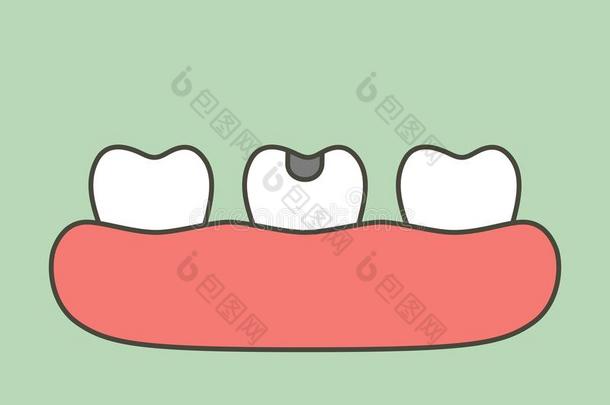 腐烂牙或牙齿的龋齿