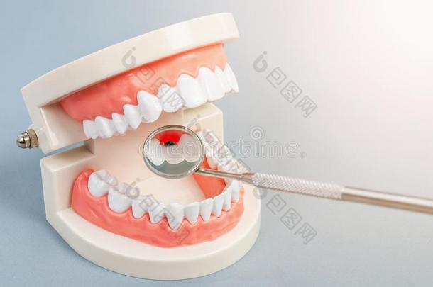 牙牙齿的龋齿向假牙和设备牙齿的.