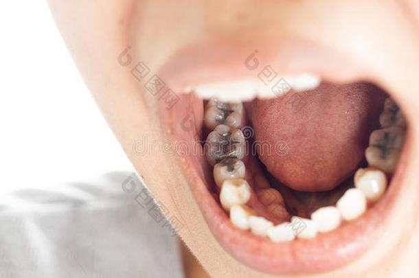 牙齿的充填料和牙齿的龋齿