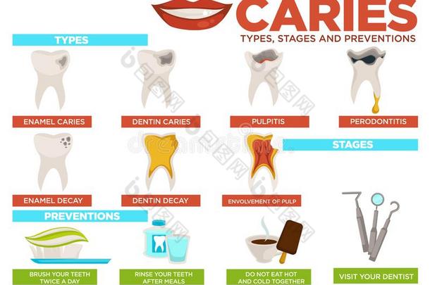 龋齿类型台和预防海报和文本矢量