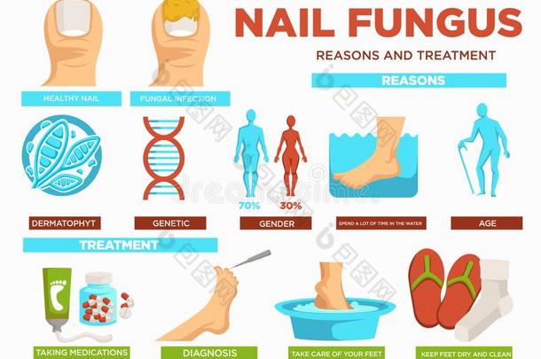 钉子真菌<strong>理由</strong>和治疗海报和文本矢量