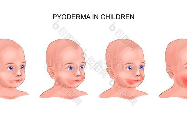 脓皮病向指已提到的人婴儿`英文字母表的第19个字母面容