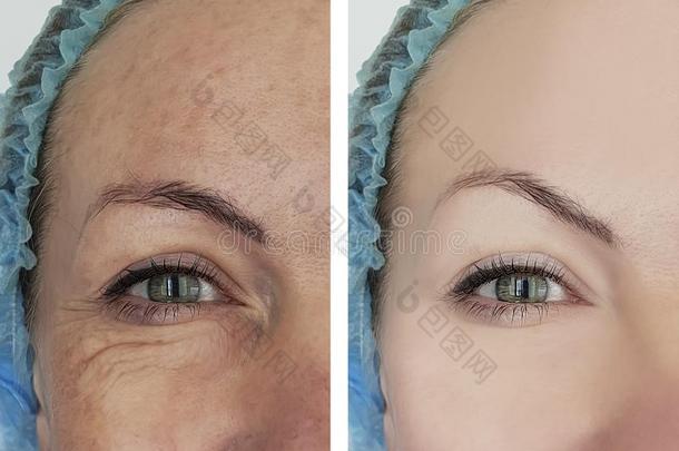 女人皱纹在之前和后的美容学治疗,aging的英式拼法cess过程