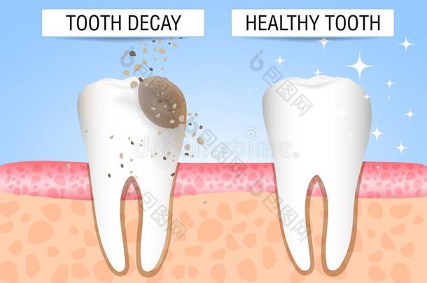 牙和龋齿和健康的牙.视觉的帮助向斯图登